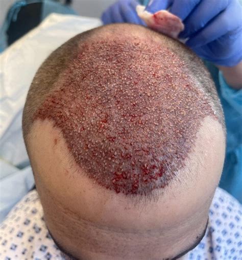 precision medical hair restoration & aesthetics|hair transplant albuquerque.